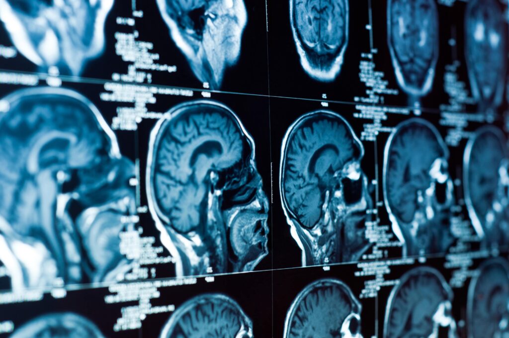 Compensation For Therapy After A Brain Injury
